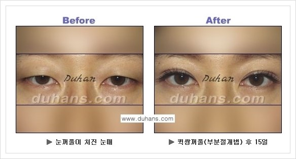 [두한성형외과 경쟁력 쌍꺼풀 재수술, 극한 재수술] - [퀵쌍꺼풀 안내] 관련 이미지 1
