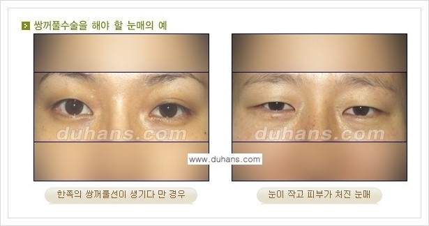 [두한성형외과 경쟁력 눈성형] - [아름답고 자연스러운 눈매를 위한 퀵쌍꺼풀 안내] 관련 이미지 1