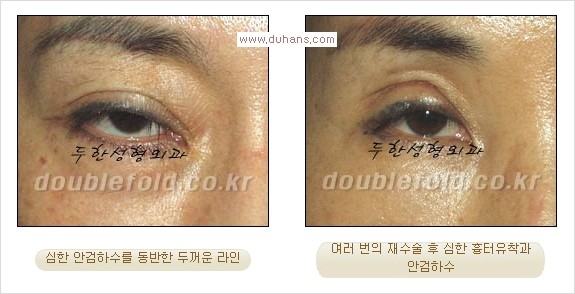 [두한성형외과 경쟁력 쌍꺼풀 재수술, 극한 재수술]- [쌍꺼풀 재수술의 성공 조건(Condition of successful reoperation) 관련 이미지 2