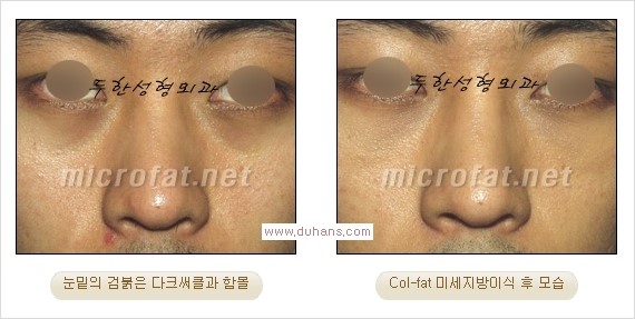 [두한성형외과 경쟁력 눈밑성형] - [눈밑 미세지방이식으로 다크써클 치료] 관련 이미지 21