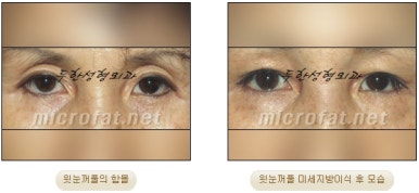[Doohan Plastic Surgery Autologous Fat Grafting] - [Sunken Eye Fat Grafting] image 9