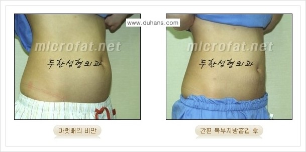 [두한성형외과 경쟁력 바디성형] - [하복부, 팔뚝, 허리선, 허벅지, 엉덩이 간편지방흡입술] 관련 이미지 15
