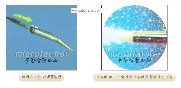 ​​[두한성형외과 경쟁력 지방흡입] - [아름다운 얼굴 윤곽선을 위한  볼살지방흡입, 턱선지방흡입 안내] 관련 이미지 2