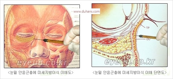 [두한성형외과 경쟁력 눈밑성형] - [눈밑 다크써클 수술 방법] 관련 이미지 9