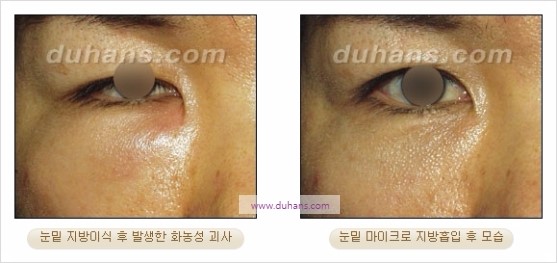 [두한성형외과 경쟁력 지방흡입] - [볼살, 턱선의 간편 지방흡입] 관련 이미지 30