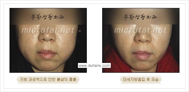 [두한성형외과 경쟁력 지방이식] - [지방이식 부작용 - 지방이식 후 지방이식 과다주입, 과다생착의 교정 안내] 관련 이미지 3