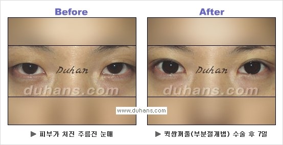 ​[두한성형외과 경쟁력 눈성형] - [자연스럽고 아름다운 쌍꺼풀의 기준] 관련 이미지 26