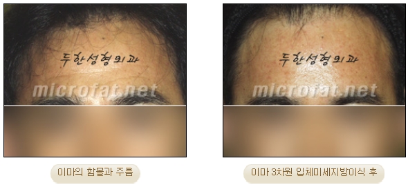[두한성형외과 미세지방이식] - [자가지방이식] 관련 이미지 7
