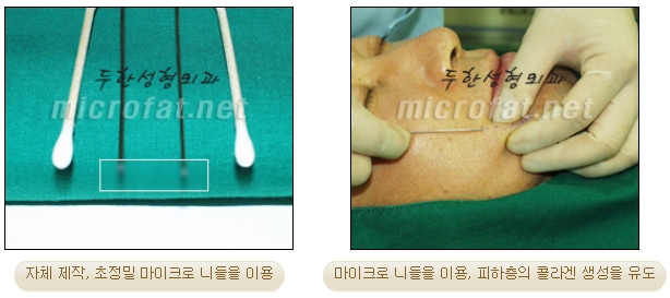 [두한성형외과 미세지방이식] - [자가지방이식] 관련 이미지 4