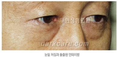 [두한성형외과 다크서클] - [하안검성형술] 관련 이미지 4