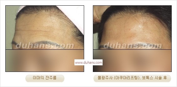 [두한성형외과 경쟁력 주름성형] - [간단하고 부작용 없는 자연스러운 주름제거 방법] 관련 이미지 17