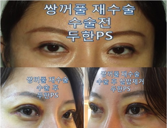 [두한성형외과-쌍꺼풀 재수술] #인아웃라인#쌍꺼풀재수술 관련 이미지 4
