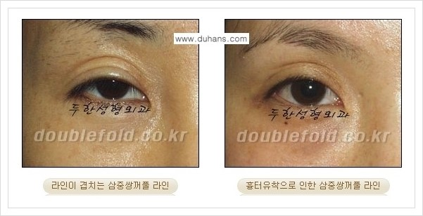 [두한성형외과 경쟁력 쌍꺼풀 재수술, 극한 재수술] - [삼중(세겹) 쌍꺼풀 라인의 교정 안내] 관련 이미지 1