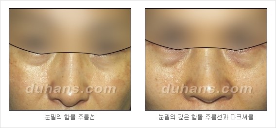 [Dr. 컬럼] - [주름교정을 위한 미세지방이식] 관련 이미지 2