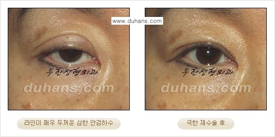 ⁠⁠⁠⁠[두한성형외과 성형 FOCUS] - [정상적인 눈매로의 복원 극한재수술 경우 ①] 관련 이미지 4