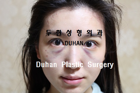 #눈밑수술 과 #쌍꺼풀 수술 , #눈밑지방이식 #인디언밴드 #앞광대주름 #눈물고랑 관련 이미지 3