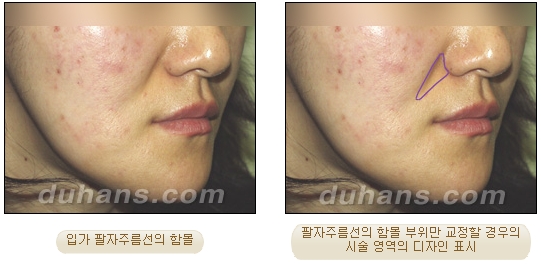 [두한성형외과 얼굴자가지방이식] - [귀족수술 입체 미세지방이식] 관련 이미지 4
