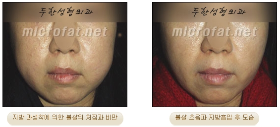 [Duhan Plastic Surgery Liposuction] - [Facial Liposuction] image 10
