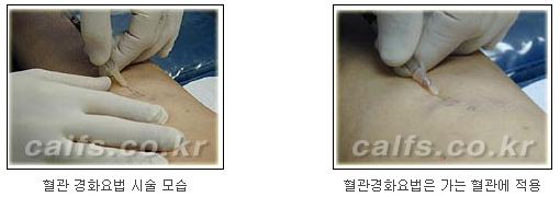 ​[두한성형외과 종아리수술] - [나에게 맞는 종아리성형방법] 관련 이미지 41