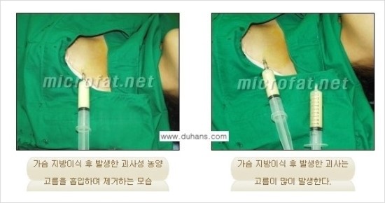 [두한성형외과 경쟁력 자가지방이식] - [지방이식 부작용의 종류와 교정방법] 관련 이미지 4