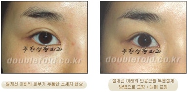 [Duhan Plastic Surgery Double Eyelid Revision Surgery] - [Ptosis, sausage eyelids] image 28