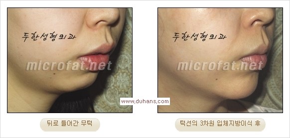 [두한성형외과 경쟁력 미세지방이식] - [부드럽고 아름다운 얼굴윤곽선 턱(하악부) 미세지방이식 안내] 관련 이미지 17