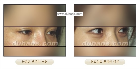 [두한성형외과 경쟁력 미세지방이식] - [눈밑 애교살을 위한 미세지방이식 2.] 관련 이미지 2