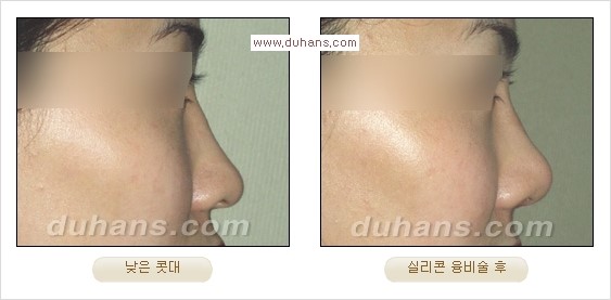 [두한성형외과 경쟁력 코성형] - [코성형을 위한 알로덤(슈어덤) 수술, 실리콘 수술 안내] 관련 이미지 30