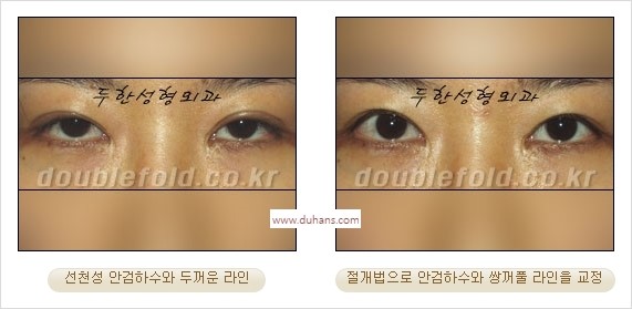⁠⁠[두한성형외과 경﻿쟁력 쌍꺼풀 재수술] - [안검하수(졸리운 눈매) 종류와 교정 방법 안내] 관련 이미지 27