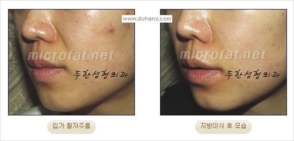 [두한성형외과 경쟁력 주름성형] - [입가주름과 코옆 팔자주름제거 지방이식 시술의 효과] 관련 이미지 12