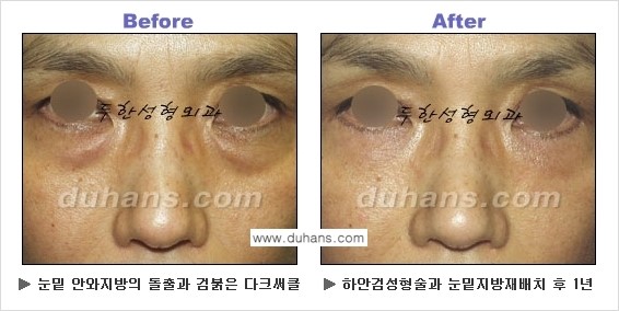 [두한성형외과의 상큼하고 환한 젊은 눈매완성] - [하안검 성형술 ②] 관련 이미지 20