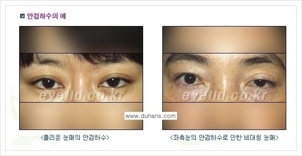 [두한성형외과 경쟁력 쌍꺼풀 재수술] - [안검하수 성형 흔한 질문과 답변 모음] 관련 이미지 1