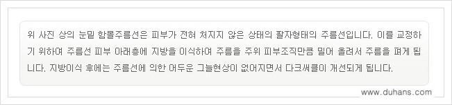 [두한성형외과 경쟁력 눈밑성형] - [눈밑 다크써클, 눈밑 주름의 교정 안내 1.] 관련 이미지 17