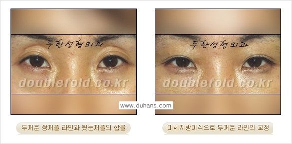 [두한성형외과 NO.1 눈성형] - [함몰된(꺼진) 눈꺼풀에서 쌍꺼풀 라인 교정 2.] 관련 이미지 6