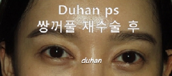 [두한성형외과] - [두한성형외과에서 두꺼운 라인 줄이는 쌍꺼풀재수술 했어요!] 관련 이미지 3