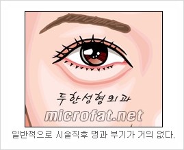 두한성형외과 눈밑성형 - 눈밑지방제거, 눈밑주름, 눈밑지방재배치 관련 이미지 9