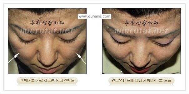 ⁠⁠[두한성형외과 경쟁력 미세지방이식] - [미세지방이식을 이용한 귀족수술 + 인디언밴드 시술 안내] 관련 이미지 1