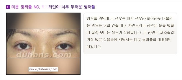[두한성형외과 경쟁력 쌍꺼풀 재수술, 극한 눈재수술] - [자연스러운 눈매로의 복원 쌍꺼풀 재수술 대상 안내] 관련 이미지 2