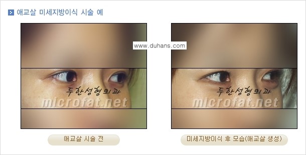 [두한성형외과 무한 경쟁력 눈밑성형] - [애교살 시술 1.] 관련 이미지 4
