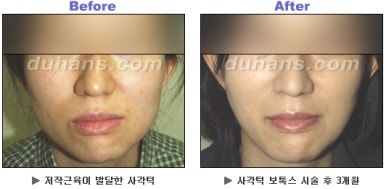 [Duhan Plastic Surgery Clinic Aesthetic Procedures] - [Square Jaw Botox] image 19