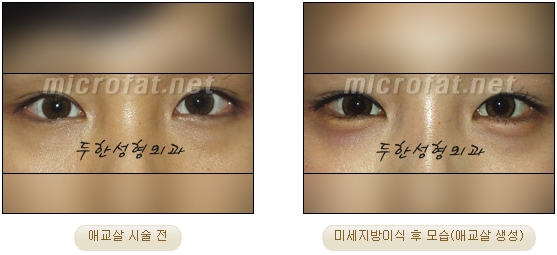 ​[두한성형외과 지방이식] - [애교살] 관련 이미지 24