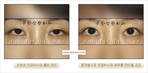 [두한성형외과 경쟁력 눈성형] - [안검하수(졸린눈매) 눈매교정 여러 가지 방법 안내] 관련 이미지 18
