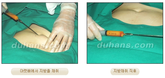 [Duhan Plastic Surgery Micro Fat Grafting] - [Upper Eyelids] image 4