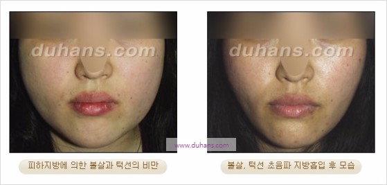 [두한성형외과 경쟁력 지방흡입] - [볼살, 턱선의 간편 지방흡입] 관련 이미지 21