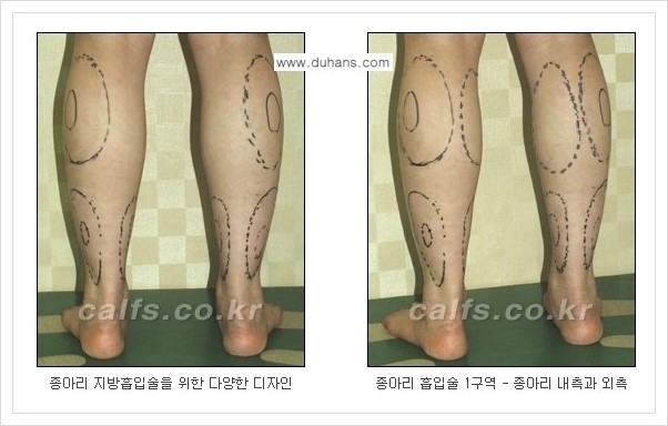 [두한성형외과 경쟁력 멀티종아리성형] - [종아리 비만의 종아리 지방흡입술 안내] 관련 이미지 4