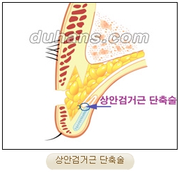 눈성형잘하는곳 두한성형외과 - 겹쌍꺼풀 관련 이미지 19