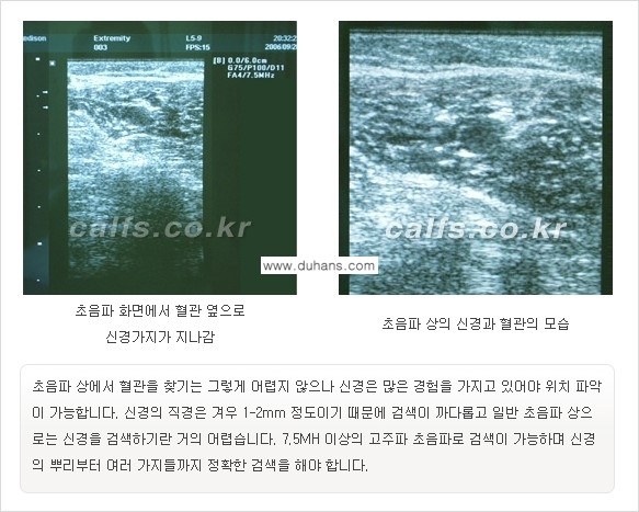 ​[두한성형외과와 날씬한 종아리 만들기!] - [간편하고 안전한 종아리 축소방법 ②] 관련 이미지 12