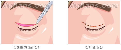 [Duhan Plastic Surgery Double Eyelid Surgery] - [Double Eyelid Guide] image 2
