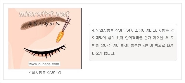 [두한성형외과 경쟁력 지방제거] - [눈 지방제거 안내] 관련 이미지 6