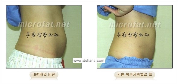 [두한성형외과 겨울엔 간편 지방흡입] - [복부, 뱃살, 아랫배, 옆구리 지방흡입 도전!] 관련 이미지 10